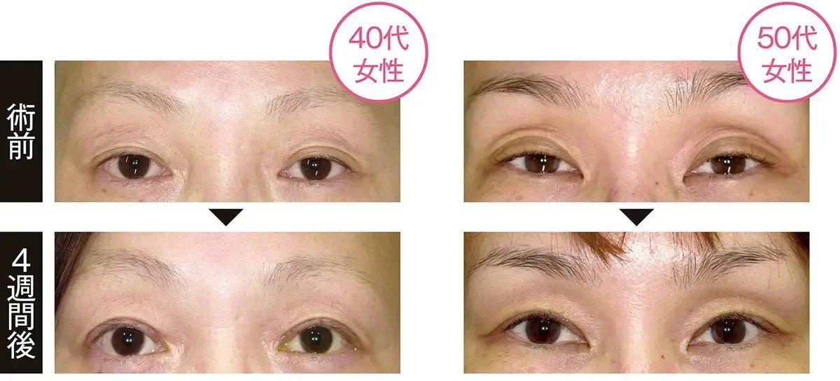 眼瞼下垂の手術例