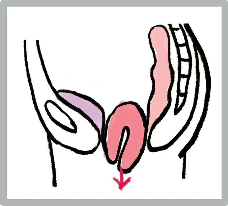 OurAge×Webエクラ　直腸瘤イラスト
