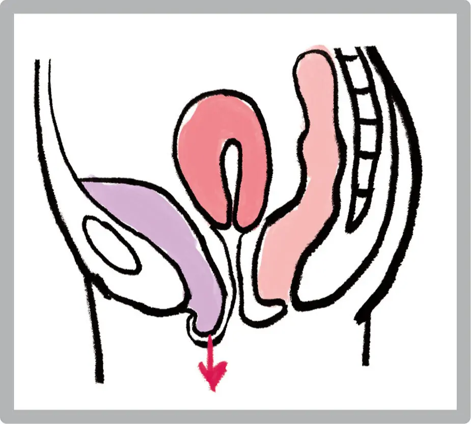 OurAge×Webエクラ　膀胱瘤イラスト