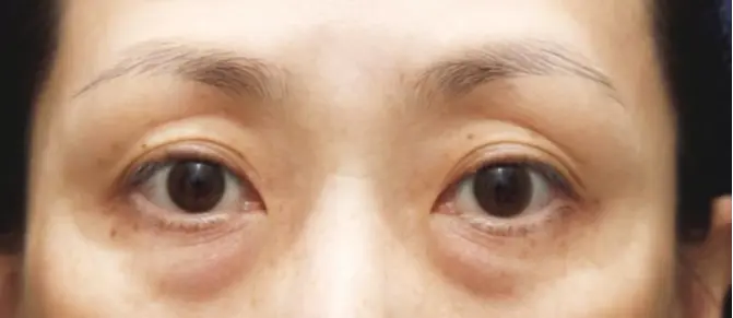 ゴルゴラインには＂腹八分目＂のヒアルロン酸＆ ベビーコラーゲン注入 　Before　