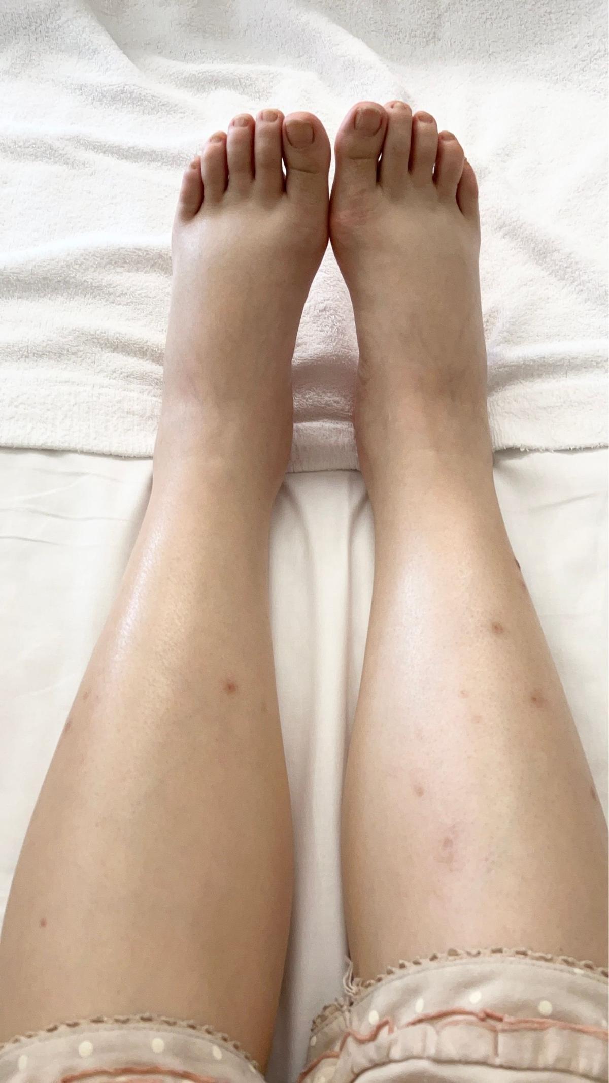 白いシーツの上に置かれた、女性の足のアップ。両足の甲とふくらはぎに、赤褐色の蚊に刺されたような小さな発疹が散らばっている。