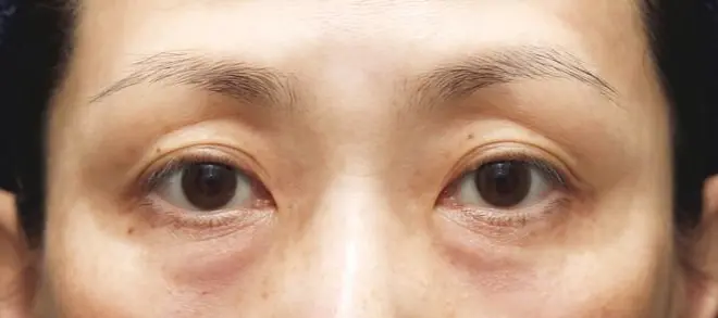 ゴルゴラインには＂腹八分目＂のヒアルロン酸＆ ベビーコラーゲン注入 　After