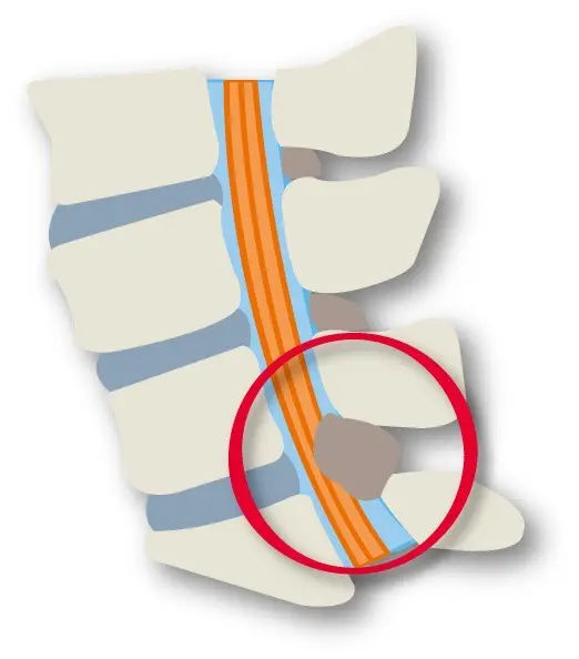 腰部脊柱管狭窄症　OurAge×Webエクラ