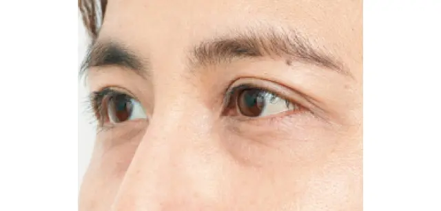 ドレープ状のたるみのある目もと