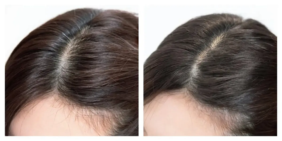 『ヒト幹細胞上清液エクソソーム頭皮スパ』の感想は？