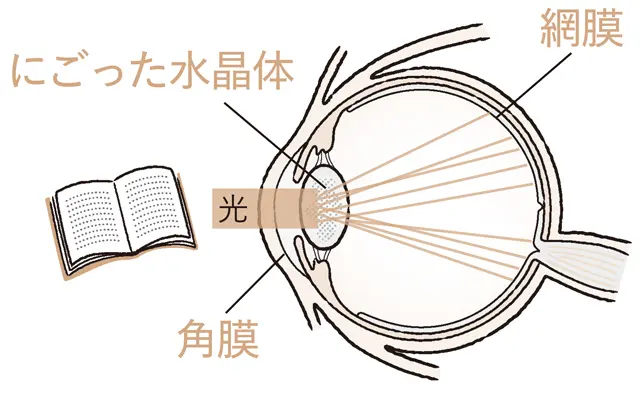 水晶体の白濁によって光が散乱してしまう 
