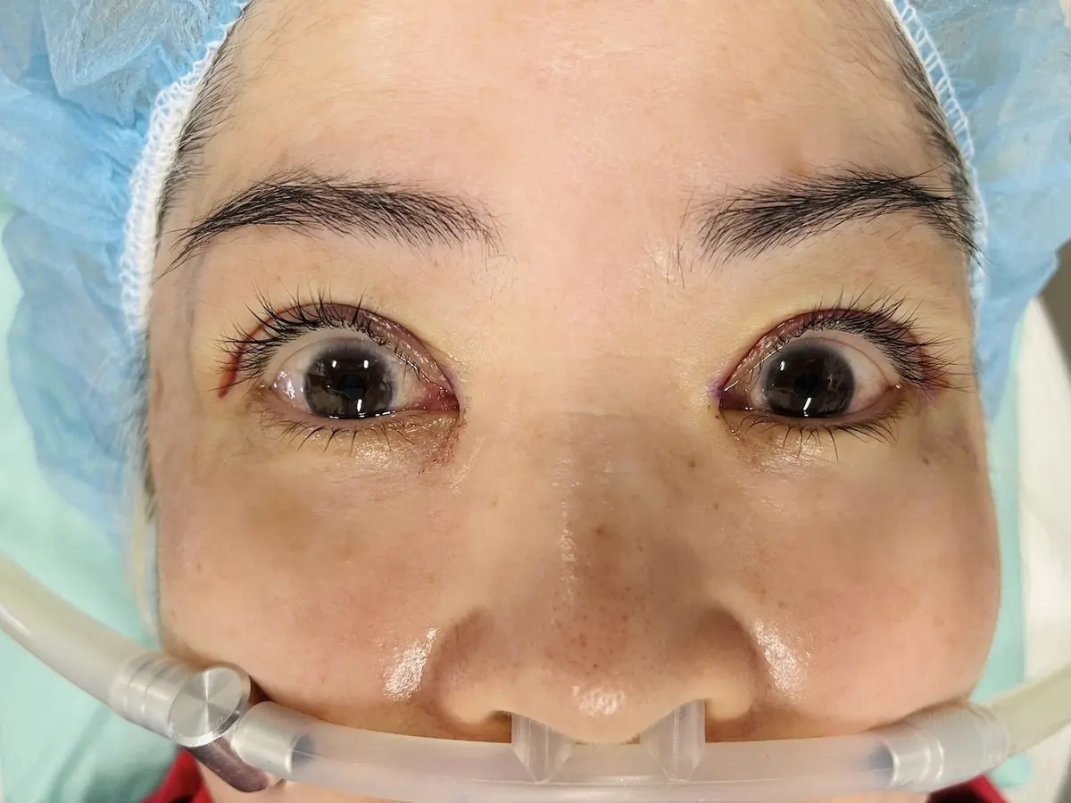 OurAge×Webエクラ　その後、先生の声からして「今、縫っているのかも」と想像できましたが、縫う感触すらありません。術後に縫合糸を見せてもらうと、ほとんど目には見えない細〜い糸！ まさにミクロの世界です。