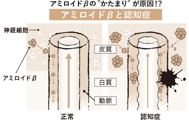 アミロイドβと認知症
