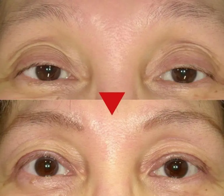 OurAge×Webエクラ　高田先生が執刀した眼瞼下垂手術の症例。50代女性のビフォー＆アフター（術後８週間）