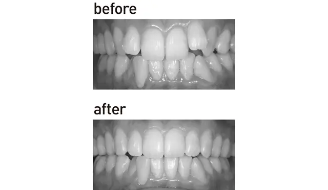 裏側部分ワイヤー矯正