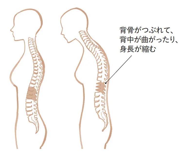 〝いつのまにか骨折〞とは？