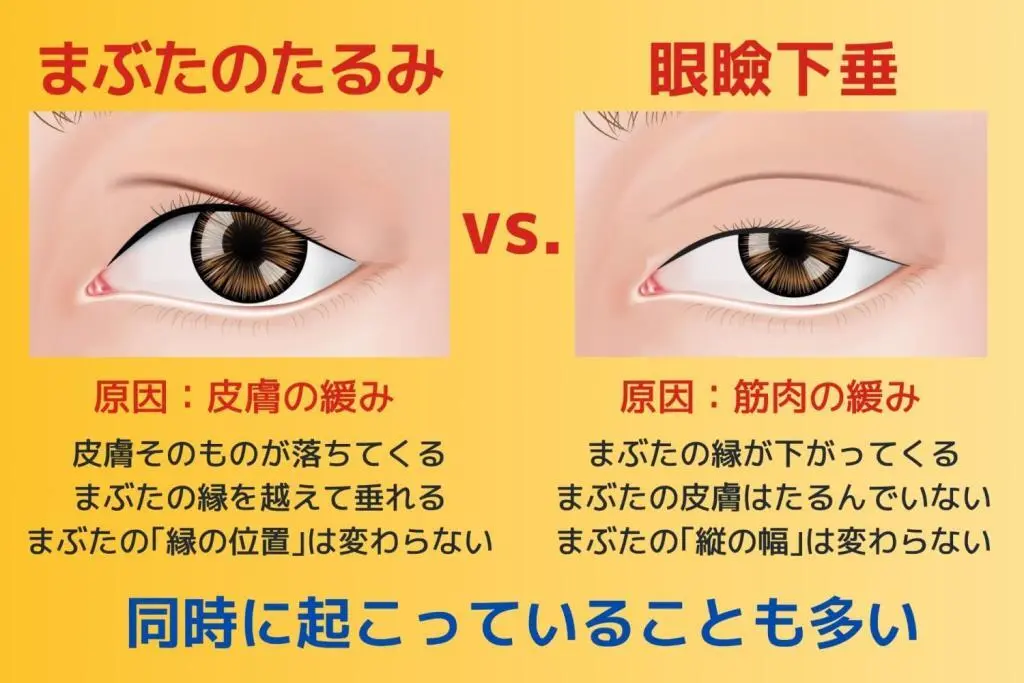OurAge×Webエクラ  まぶたのたるみvs.眼瞼下垂　同時に起こっていることも多い