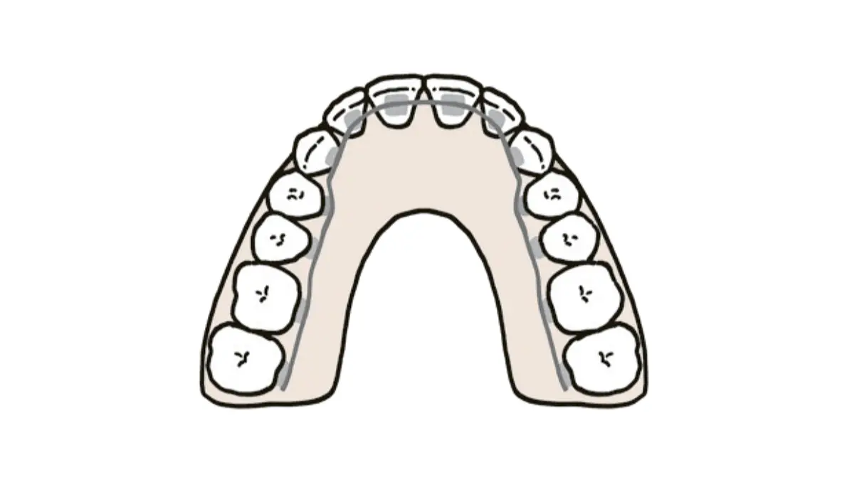 50代　歯並び　対策　ワイヤー矯正　病院　歯列矯正　裏側矯正　イメージイラスト