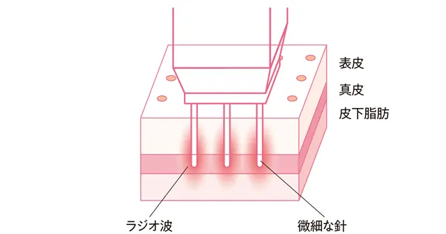 ポテンツァ（ニードルRF）