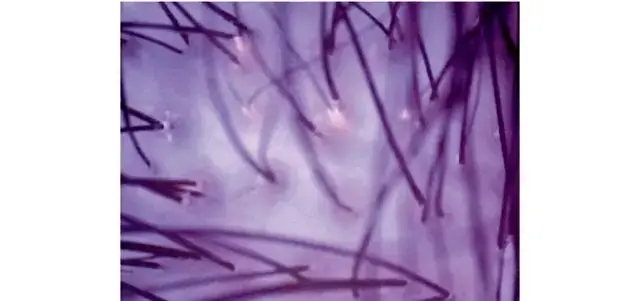 光っている部分が、毎日のシャンプーでは落としきれず毛穴に残っていた、酸化皮脂や老化脂。これが頭皮老化の一因。