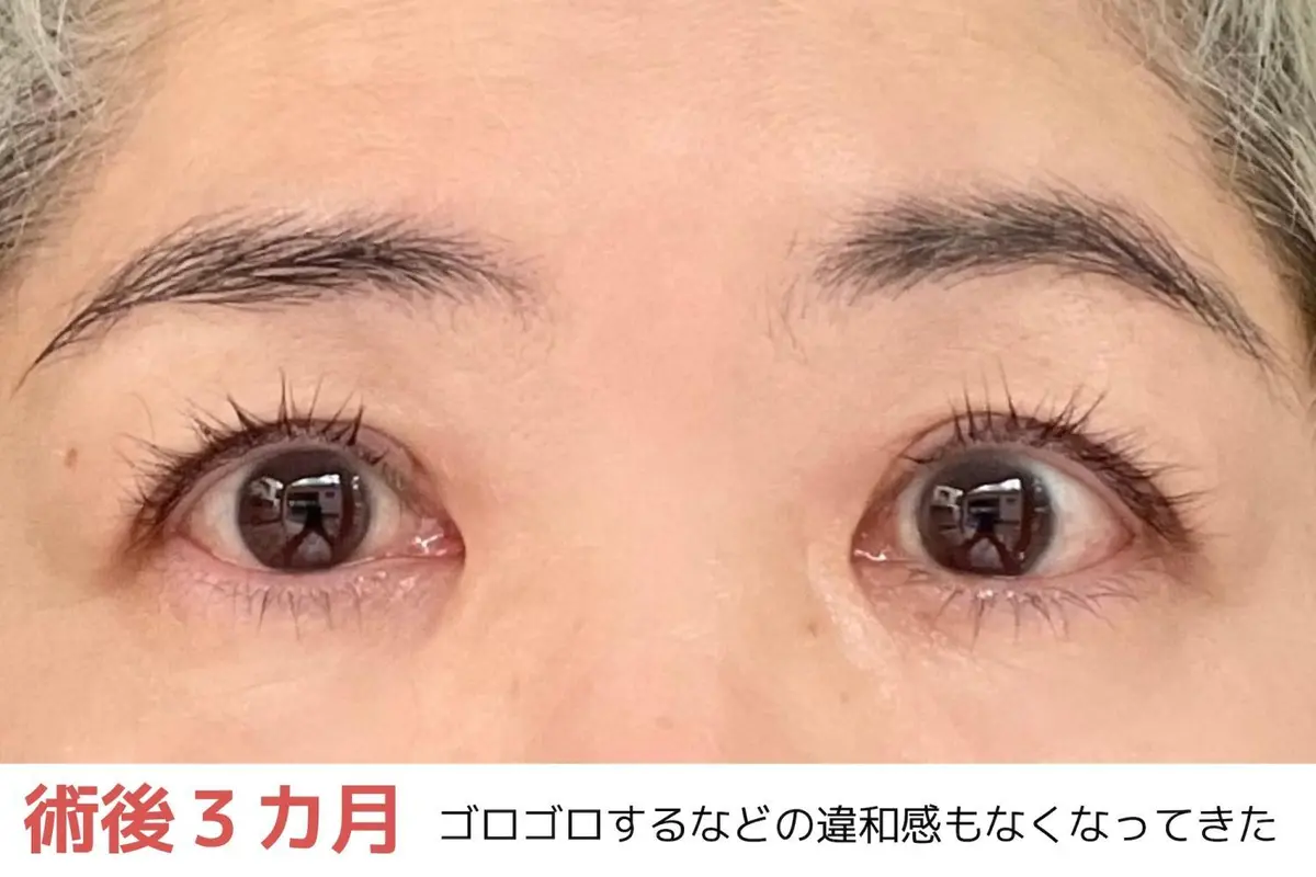 OurAge×Webエクラ　術後３ヵ月　ゴロゴロするなどの違和感もなくなってきた