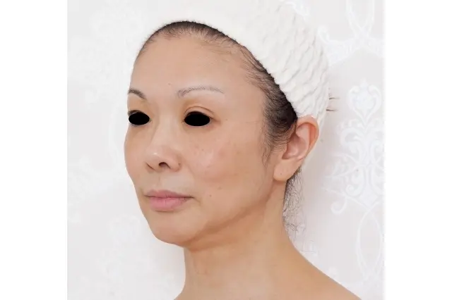 プロファイロ　施術後