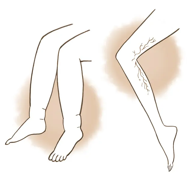 むくみ・浮き出る血管