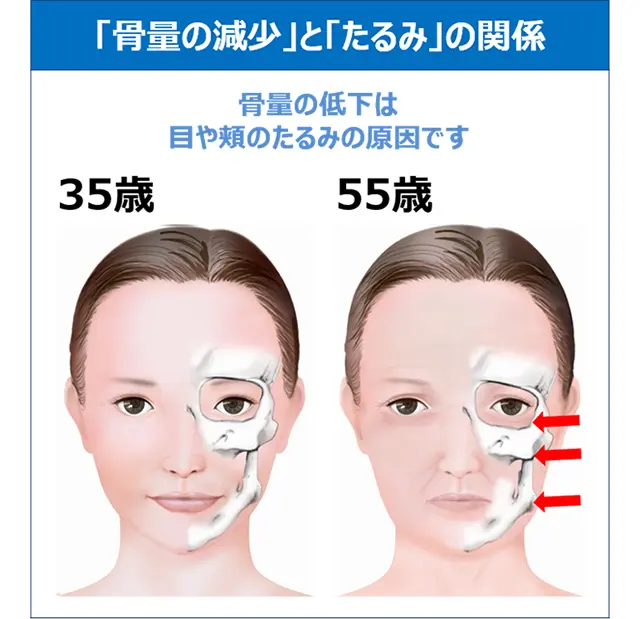 骨密度とたるみの関係