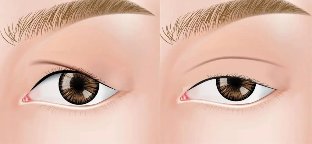 OurAge×Webエクラ  似ているようで違う「まぶたのたるみ」と「眼瞼下垂」