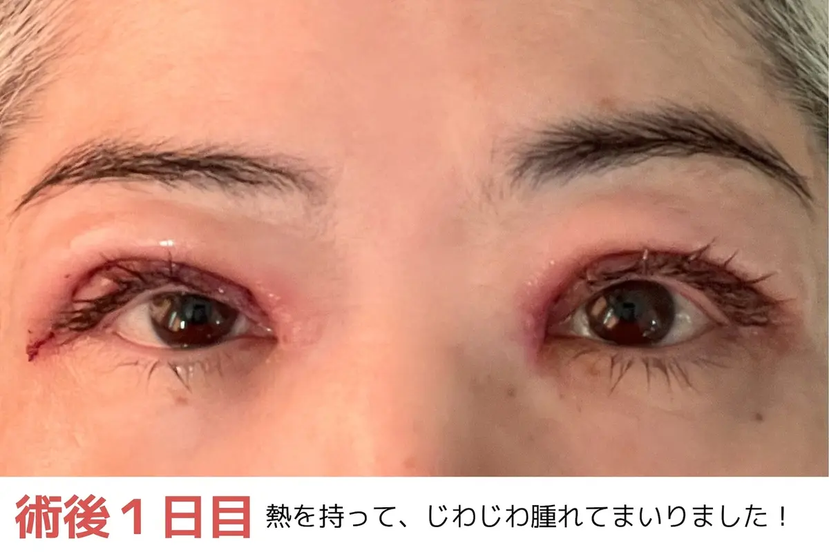 OurAge×Webエクラ　術後1日目　熱を持って、じわじわ晴れてまいりました！