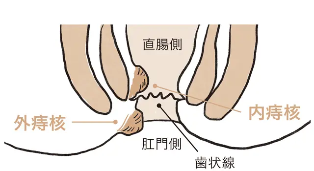 痔核（いぼ痔）
