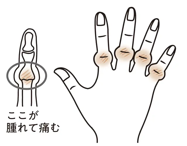 ブシャール結節