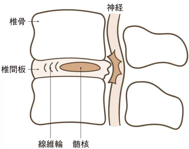 痛みの原因のひとつ