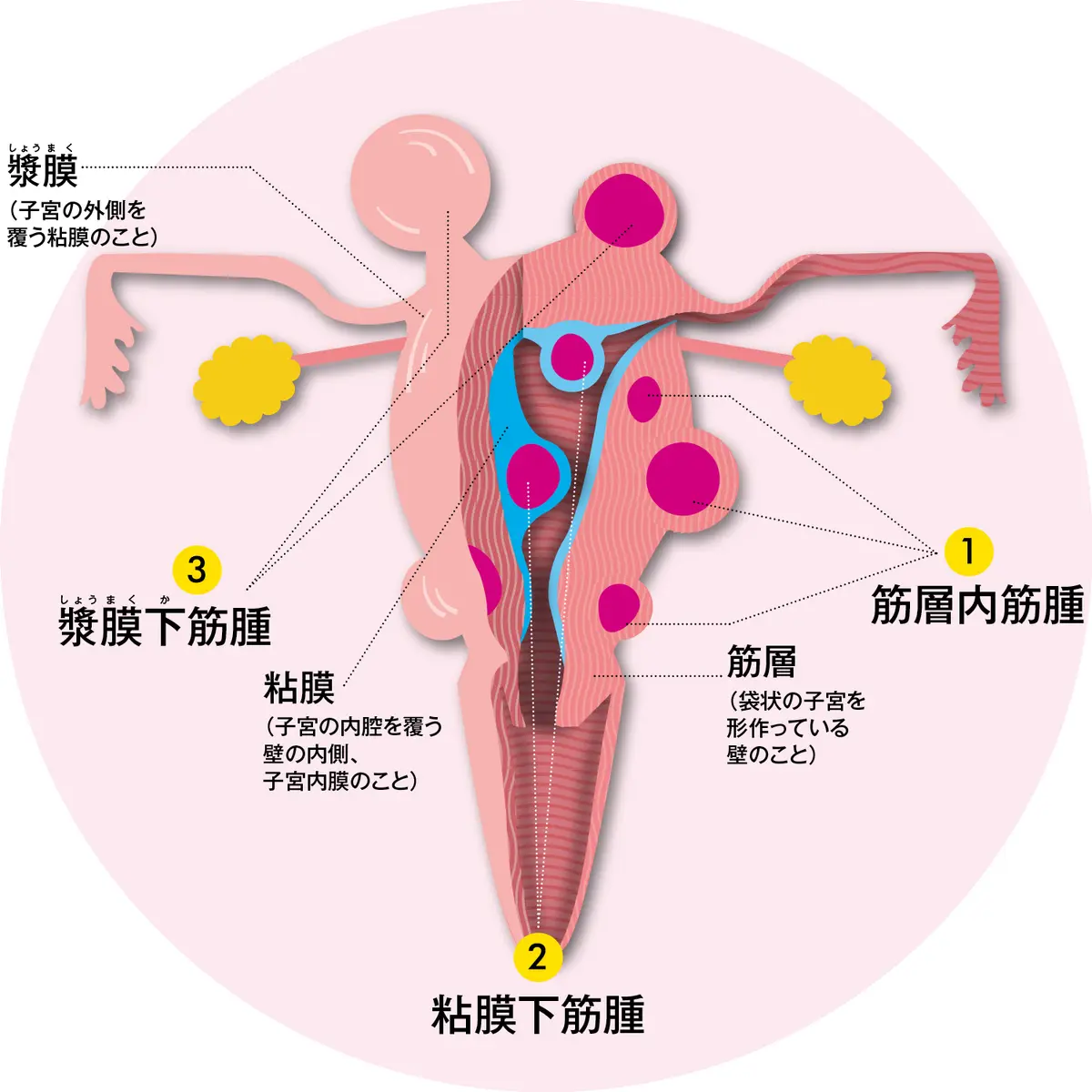 OurAge×Webエクラ　筋腫は大きく分けて3タイプ