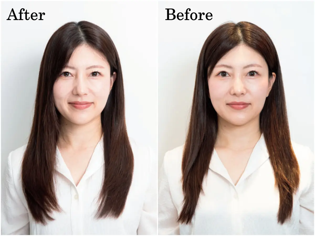 kakimoto armsの『ヒト幹細胞上清液 エクソソーム頭皮スパ』のビフォーアフター