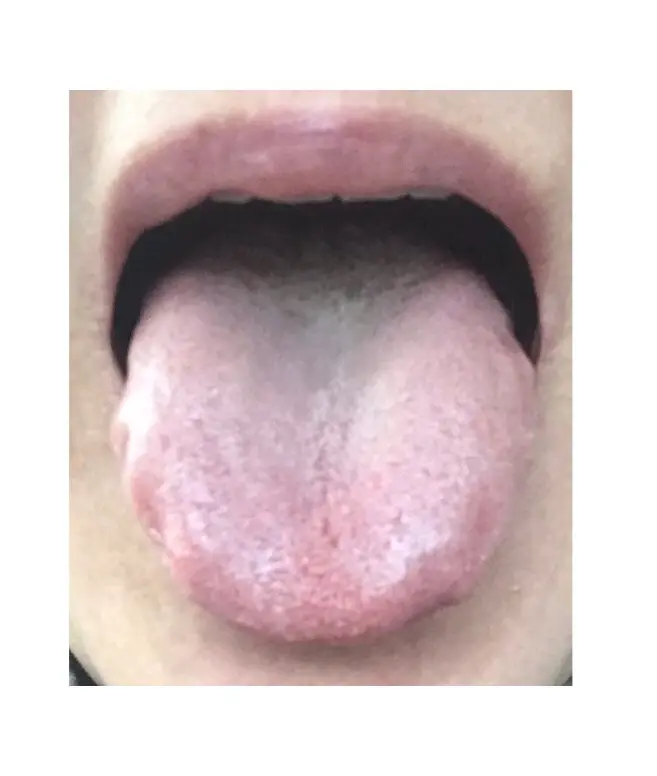 OurAge×Webエクラ　腎の働きや胃腸の働きが弱っている舌の状態