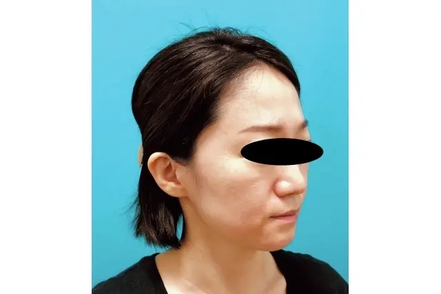 ウルトラフォーマーⅢ　施術前