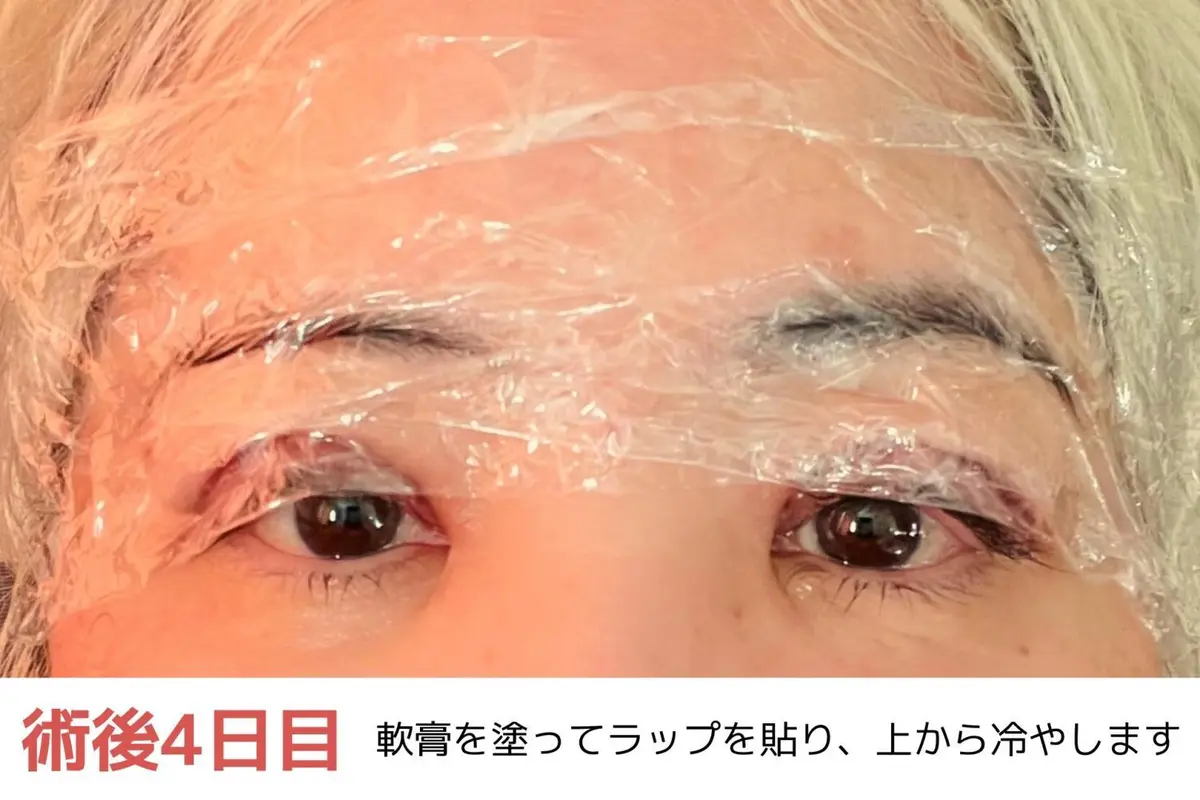 OurAge×Webエクラ　術後４日目　軟膏を塗ってラップを貼り、上から冷やします