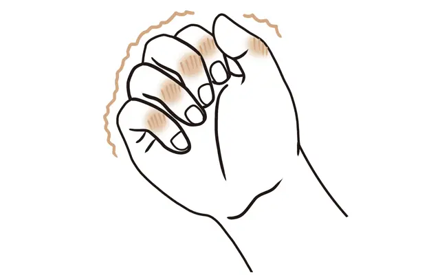 へバーデン結節は朝起きたときに症状が出やすく、