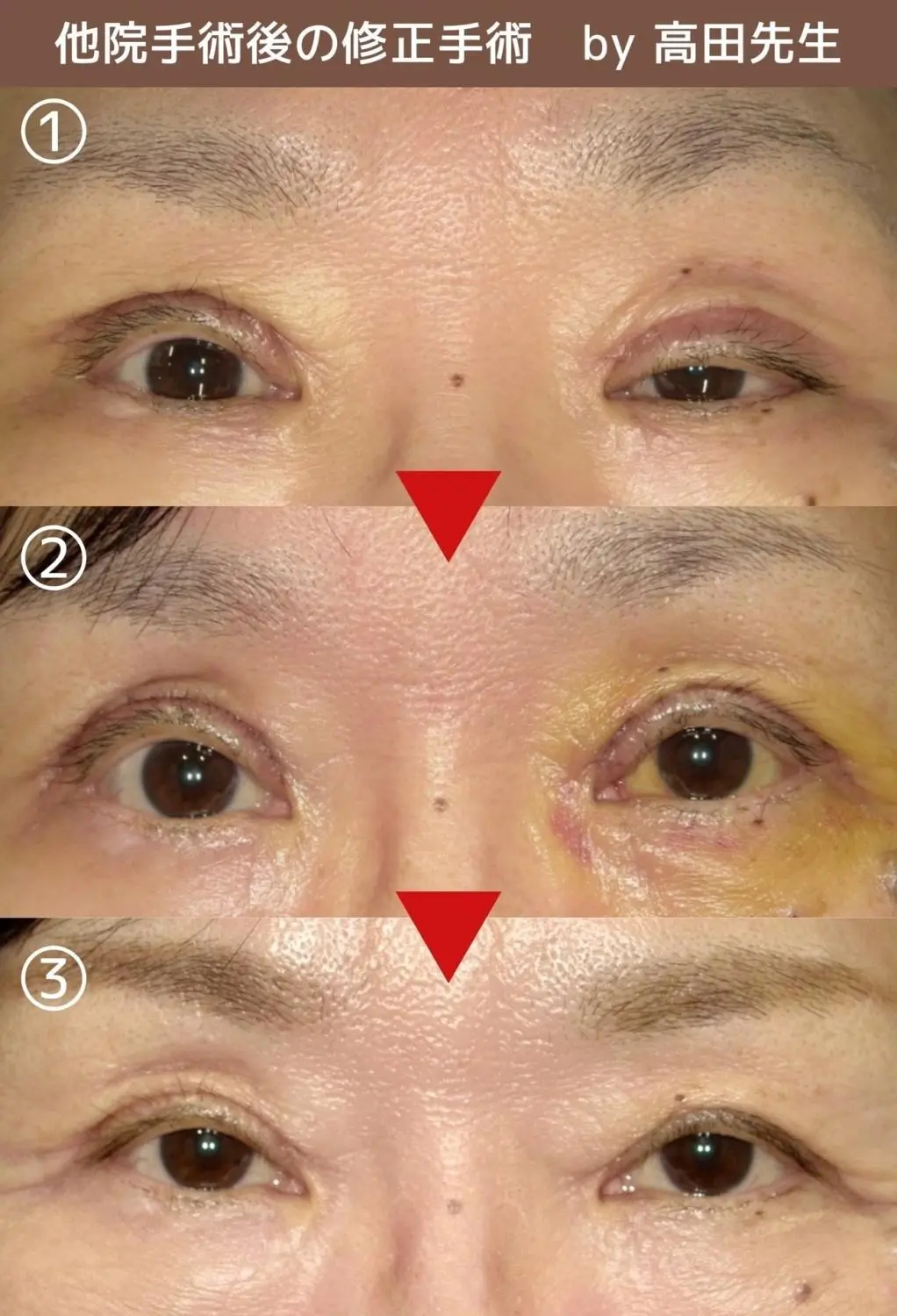 OurAge×Webエクラ　術後