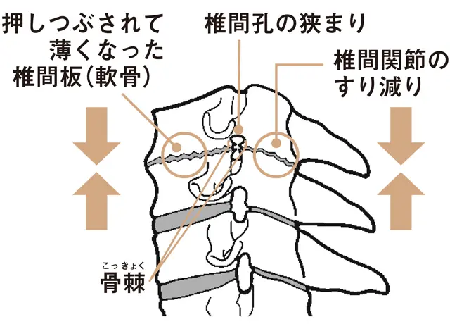 頸椎に異常が出たとき