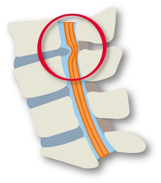 OurAge×Webエクラ　椎間板ヘルニア