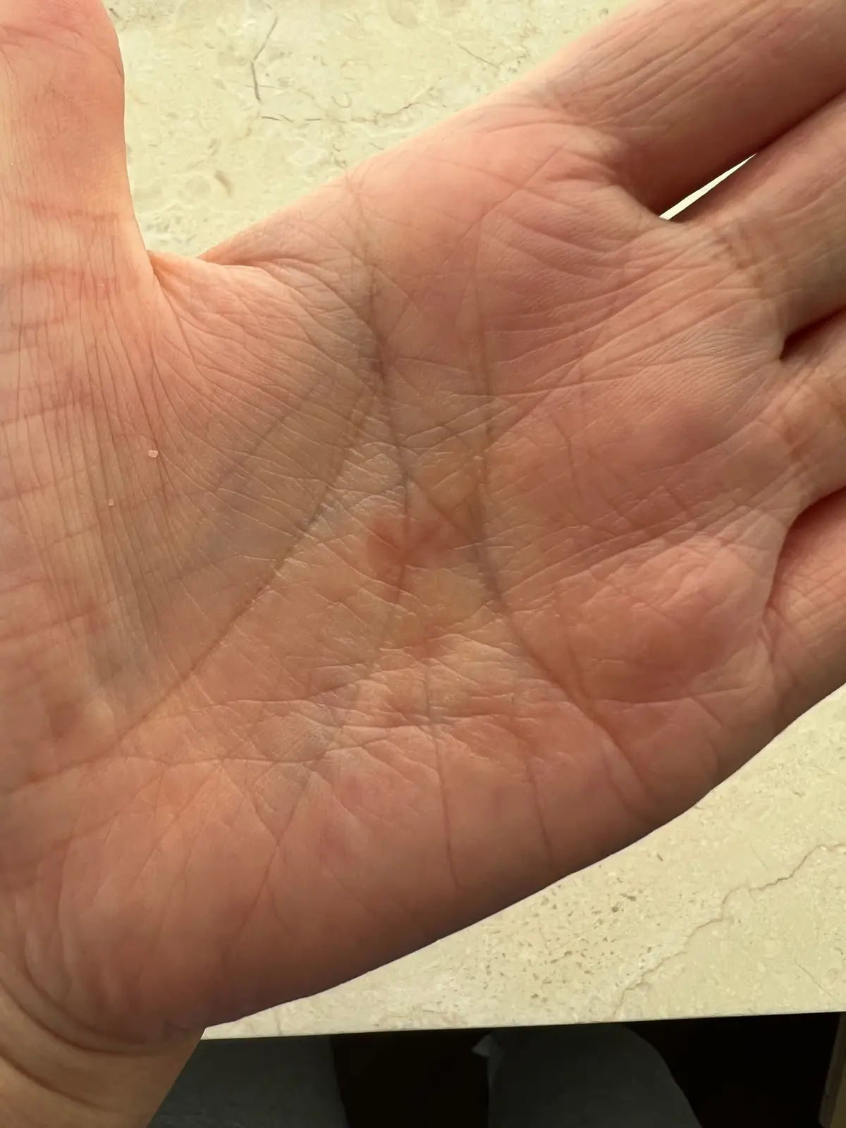 主婦手湿疹。手のひらの皮ムケがなくなり、地図みたいな赤みも引きました。