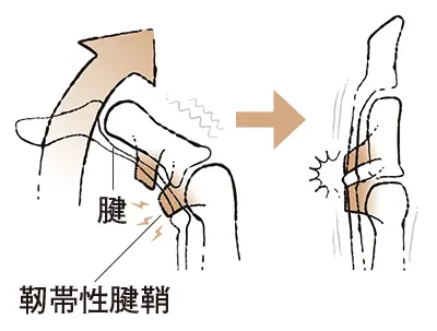 更年期の手指問題 ばね指