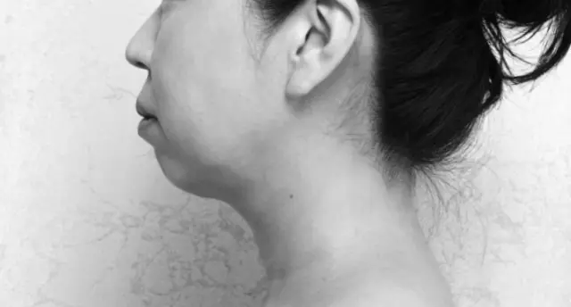 【施術前】あごと首の境目があいまいに