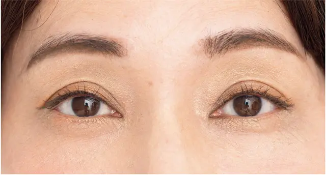 下がり二重をラインで断ち切り、明るめカラーでふっくらと