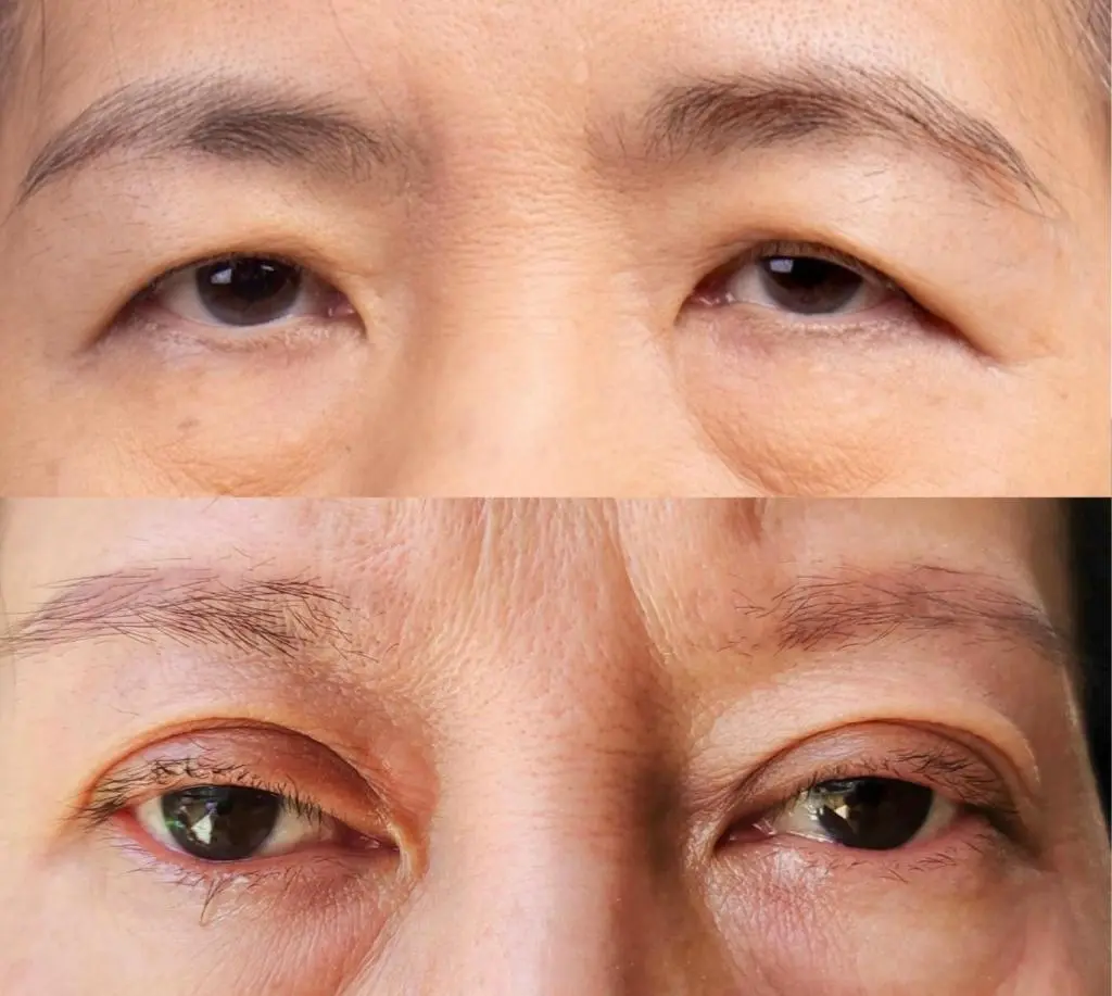 OurAge×Webエクラ　（答え：上がたるみ、下が眼瞼下垂）