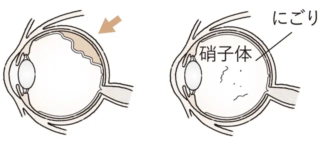 急に増えた場合は網膜剥離かも！？
