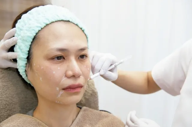 顔の構造を知りつくした先生が適切な注入場所をデザイン