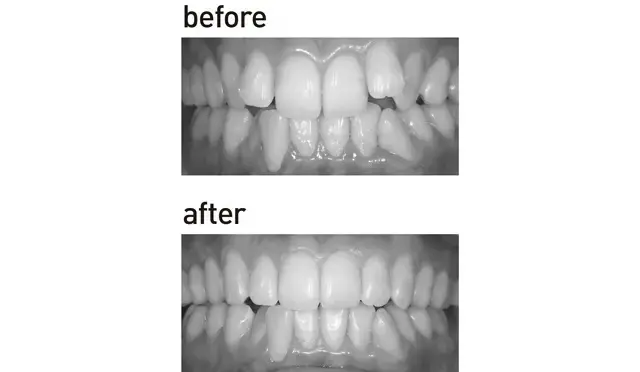 【大人の「歯の見た目」メンテナンスまとめの画像_14