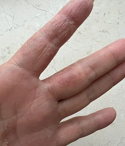 左の人さし指と、中指の股の部分も荒れていてかゆい。