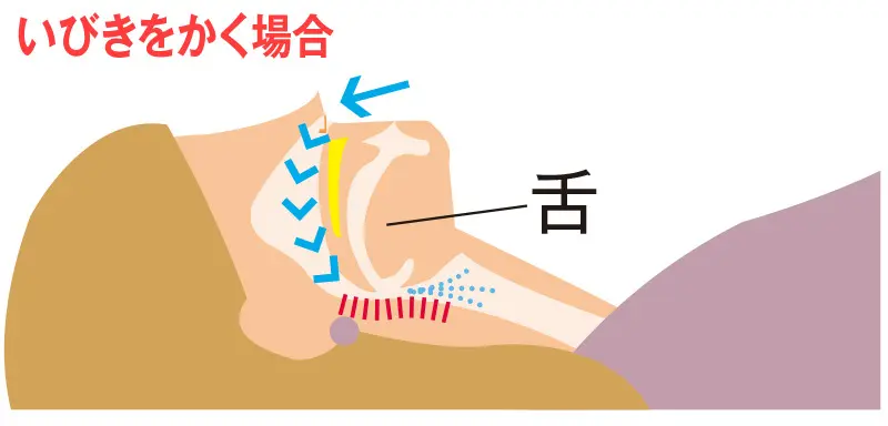 OurAge×Webエクラ　いびきをかく場合／睡眠中は筋肉が緩み、重力で舌の付け根が喉元に落ち込みます。また、睡眠中は副交感神経が優位になるため、上気道の粘膜が厚くなることも、気道が狭くなる原因です