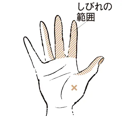 3. 人さし指や中指などがしびれる “手の画像_2