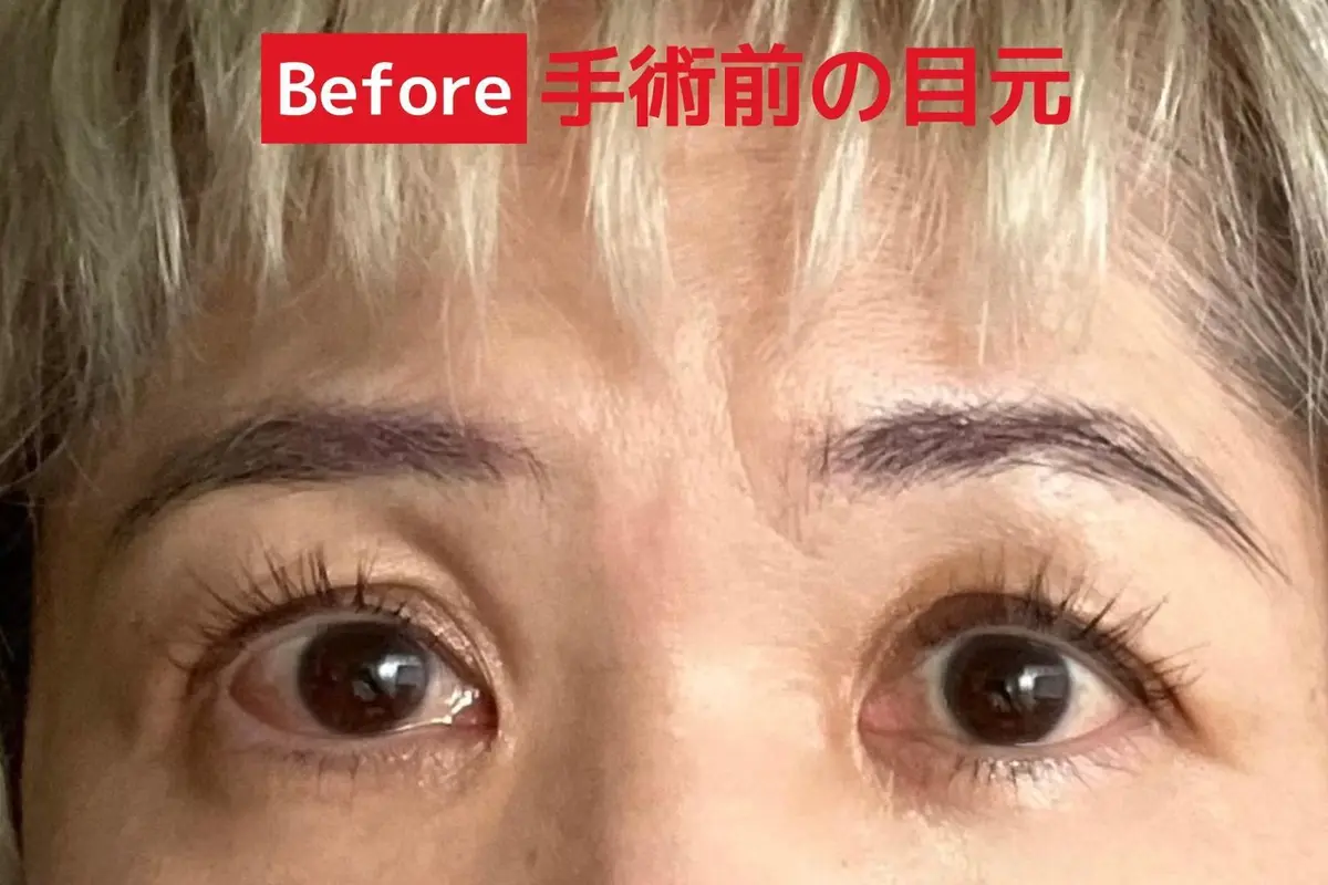 OurAge×Webエクラ  Before 手術前の目元
