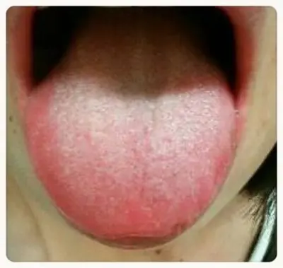 OurAge×Webエクラ　肝臓が悪い　舌